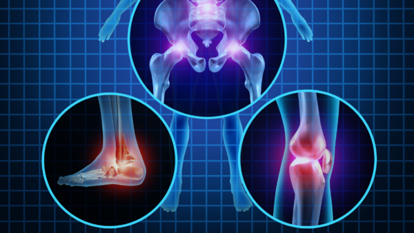 Illustration of osteoporosis