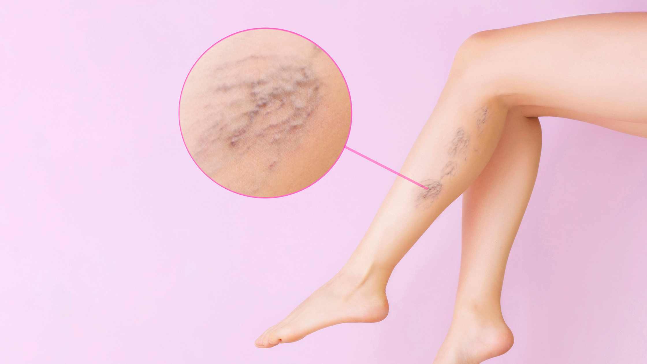 naked human legs and a close-up of varicose veins