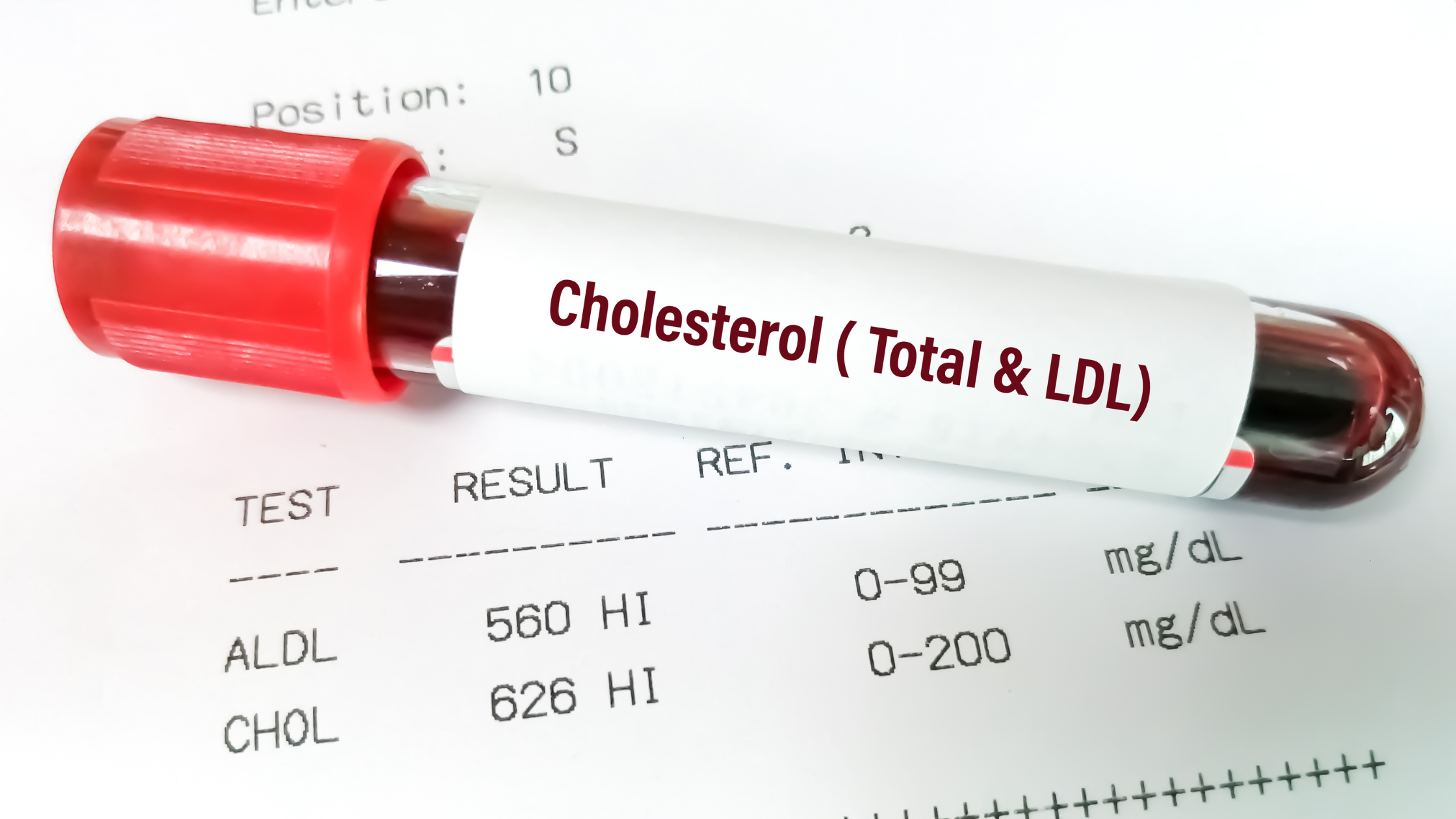 test tube of blood labeled "cholesterol"