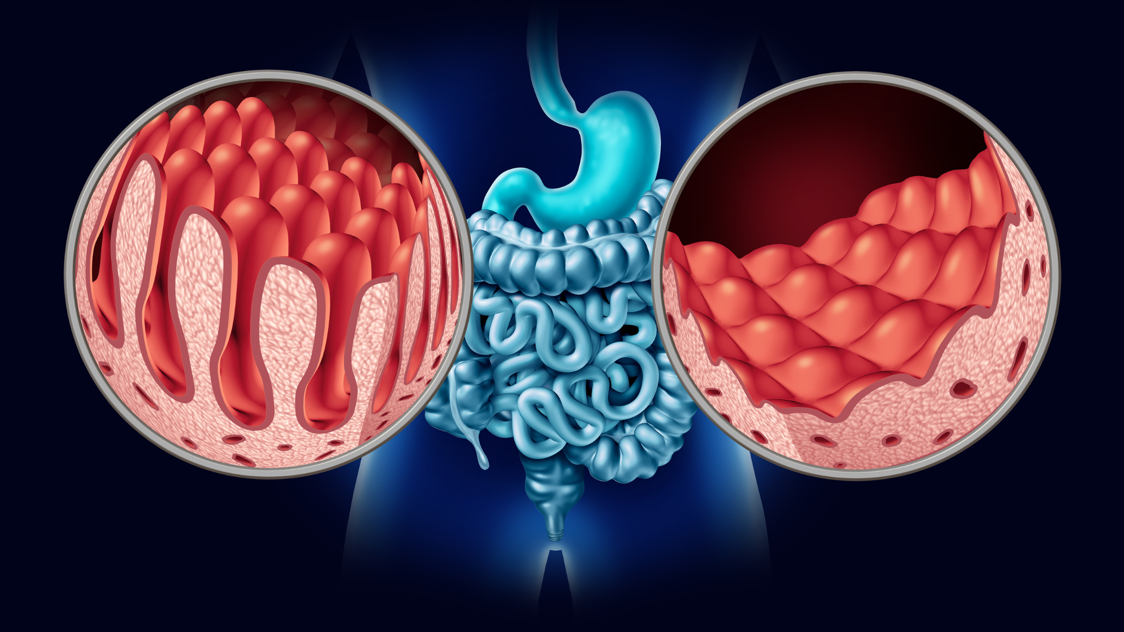 images of both a normal and an inflamed small intestine