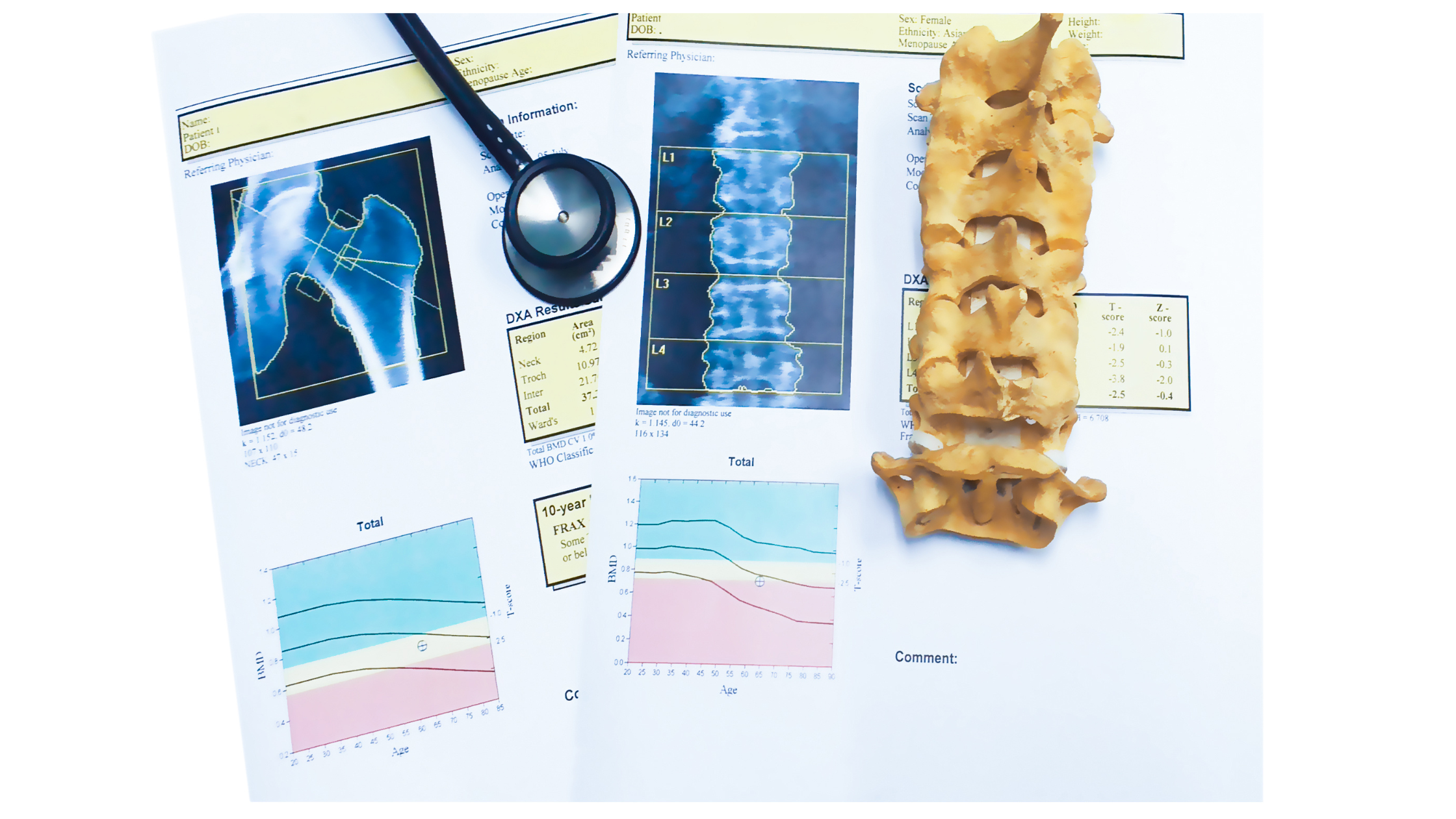 stethoscope and a partial spinal cord sitting on medical charts