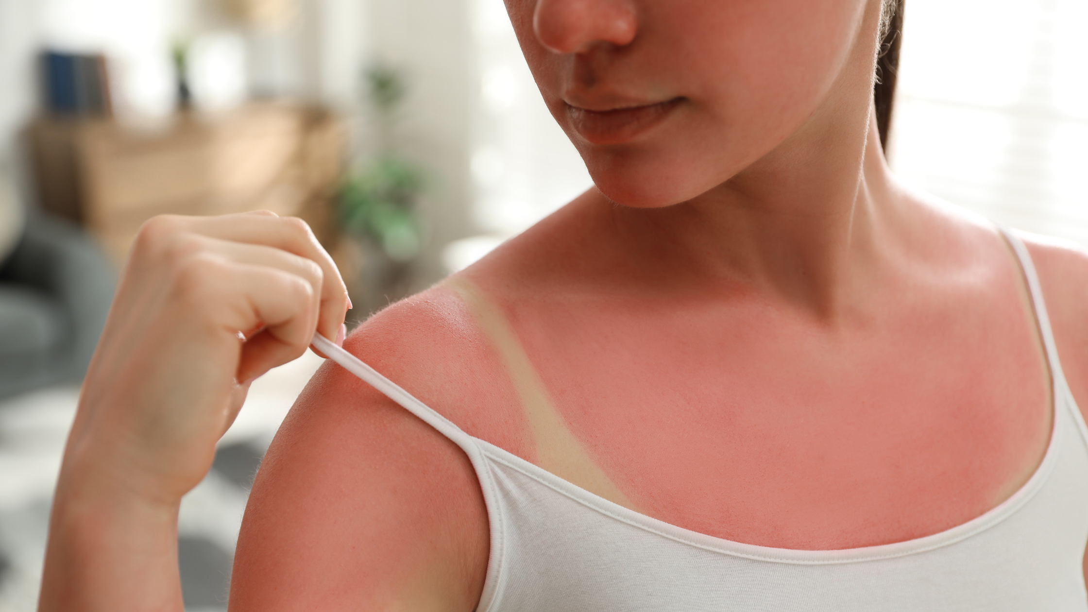 woman pulls down her tank top strap to reveal sunburn lines