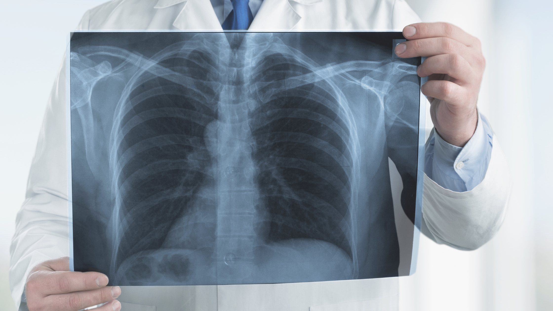 doctor holds up an x-ray of a human chest