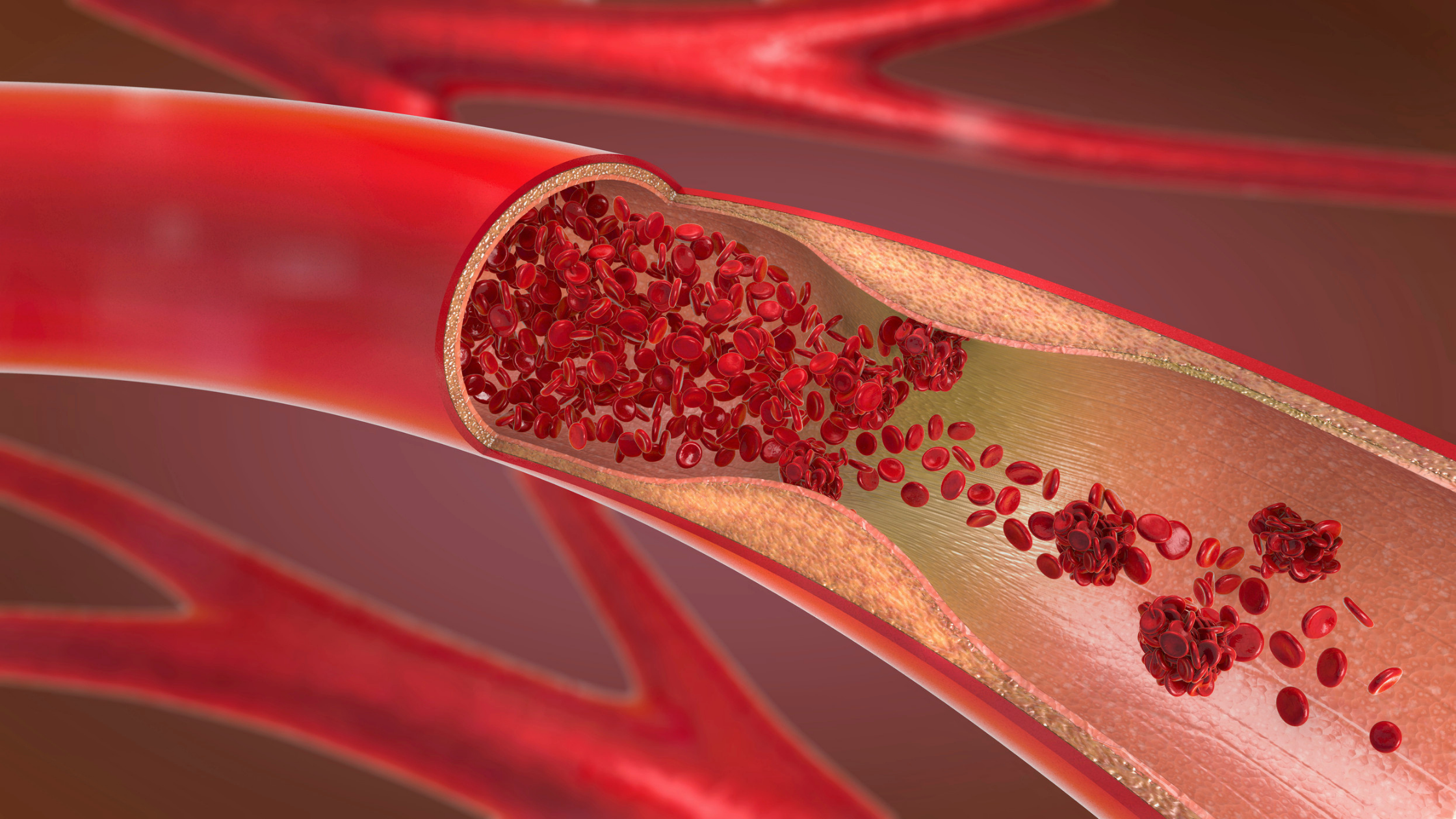 Layered illustration of a blood vessel with red blood cells building up because of a partially clogged artery