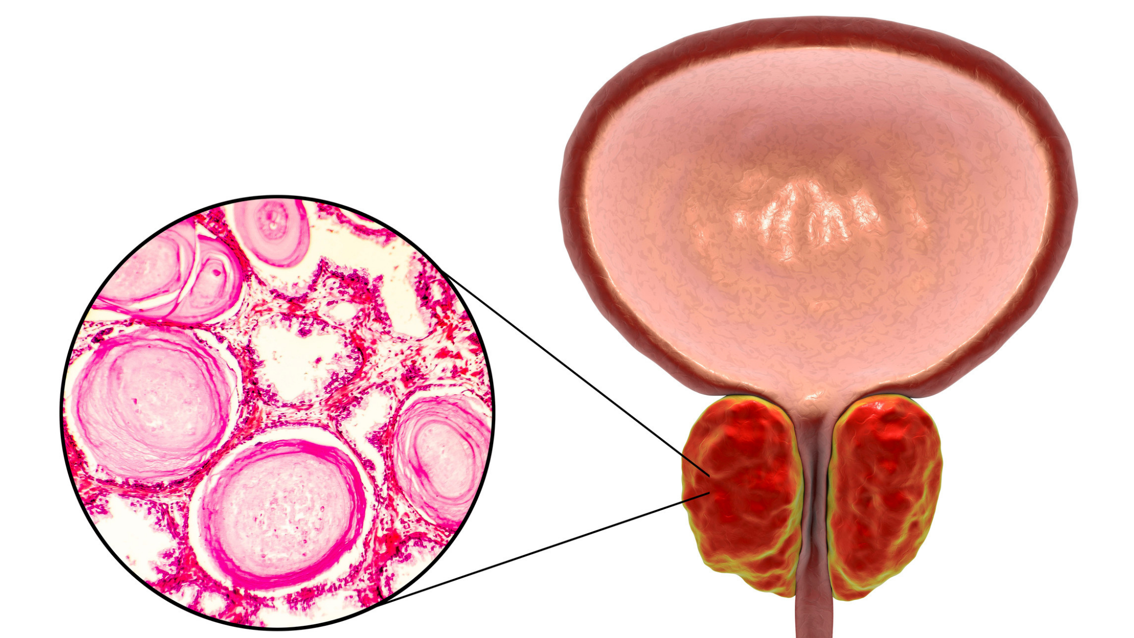 Illustration of a prostrate highlighting area that can become inflamed